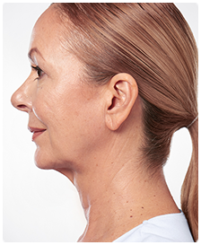 Kybella-Patient 7 - After