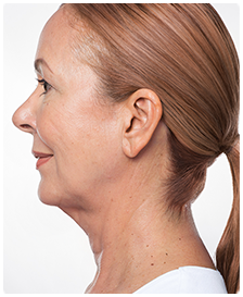 Kybella-Patient 7 - Before