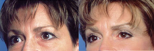 Before Browlift | After Browlift