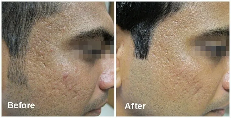 before and after results of fractora face