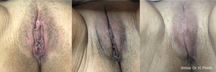 Womans vagina Before - 4 Weeks After - 3 Weeks After 2nd Treatment