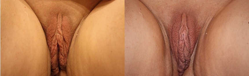 Womans vagina before and after Inmode treatment