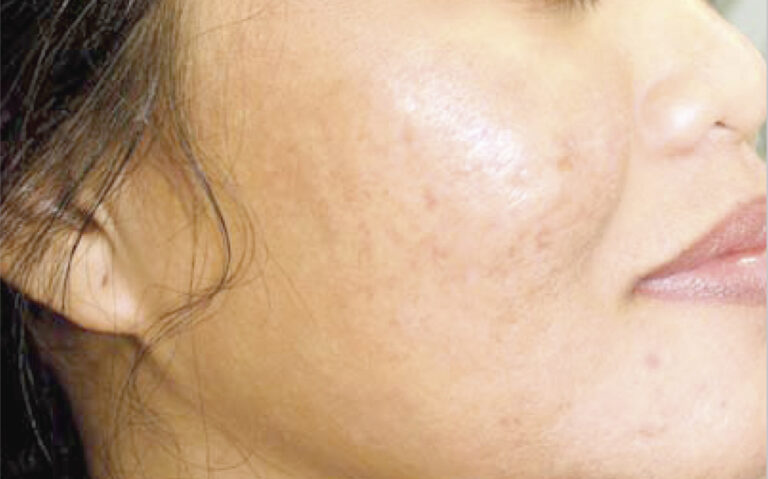 ProFractional - After 3 Treatments