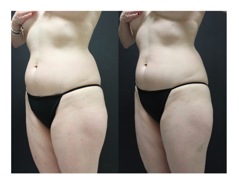 Womans torso and thighs before and after receiving Ultrashape Power Treatment