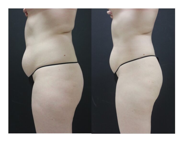 Womans torso and thighs before and after receiving Ultrashape Power Treatment