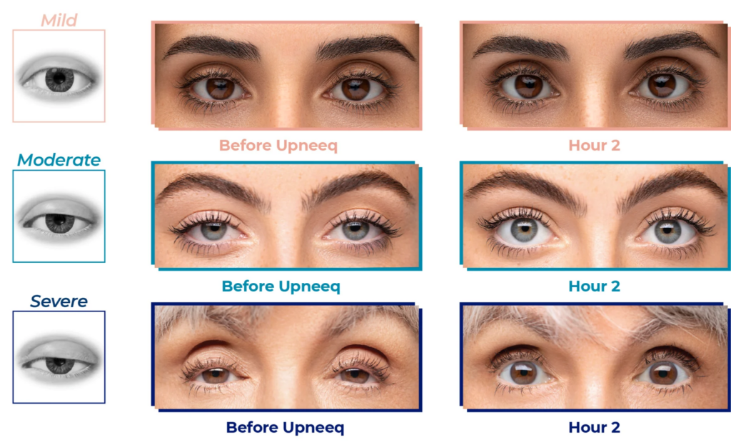 3 sets of before and after treatments of Upneeq to the eyes