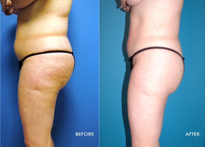 Womans torso before and after Vaser Shape procedure