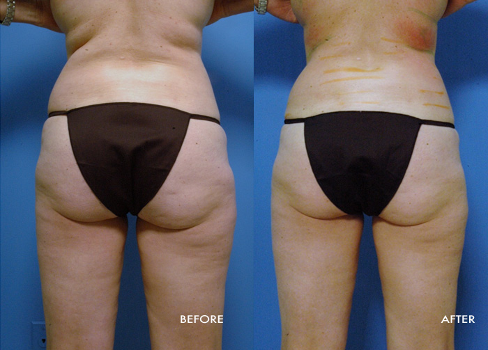 Patient 11--8 treatments of the trunk: Lost 5.11" at the waist, 2.95" at the hips