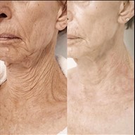 Before and after results of deep laser resurfacing of the neck