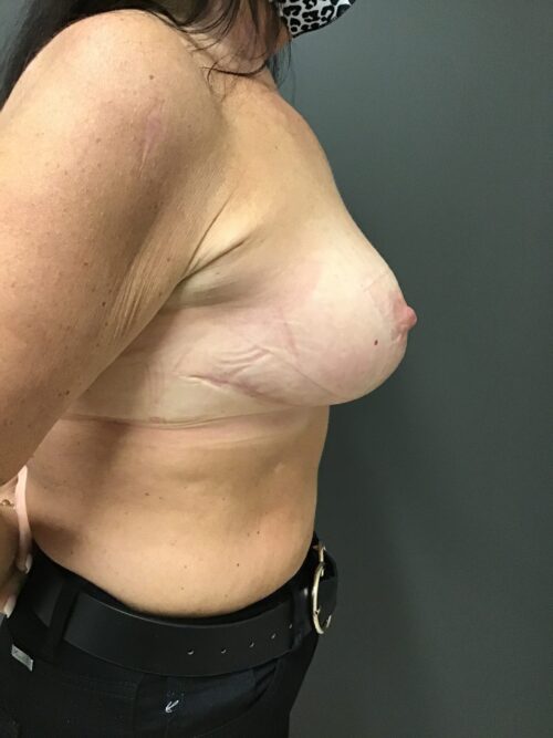 Post breast reduction results