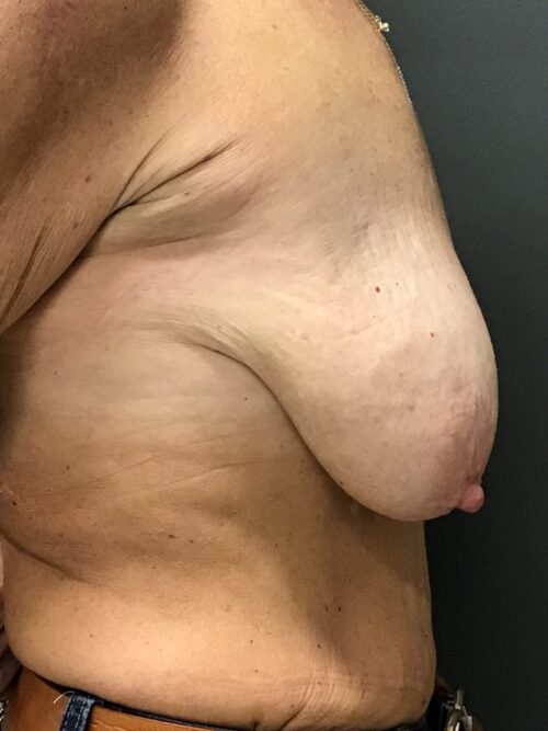 Large sagging breasts