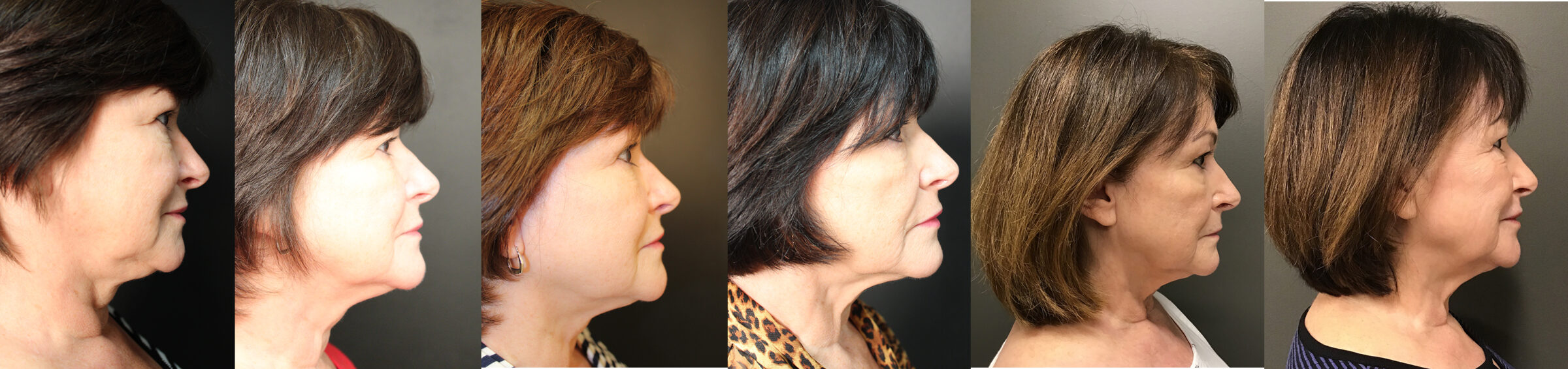 Pre Profound treatment, 3 months, 6 months, 3 years, 6 years, post single Profound Treatment This patient then decided to do a second Profound treatment and to add a CO2RE laser at that time, therefore frame # 6 is shown at 6 years post the 1st treatment, while the last frame is shown 6 weeks after the 2nd Profound plus CO2RE treatment.