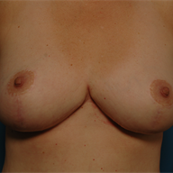 Post breast reduction results