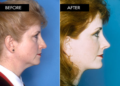 52 year old - Facelift, Brow Lift, Upper and Lower Blepharoplasty, Rhinoplasty, Chin Implant and CO2 Laser Resurfacing.