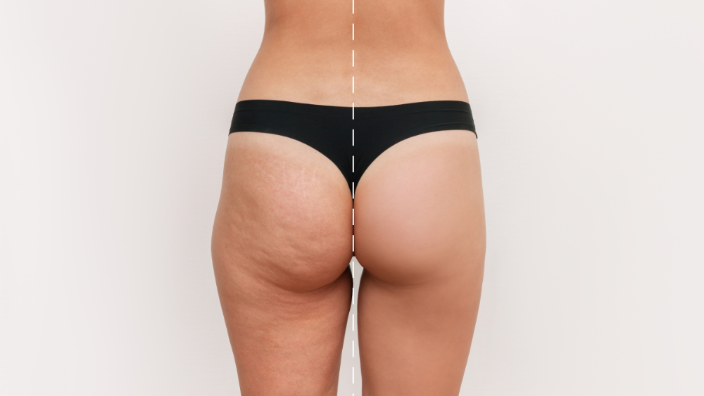 Young woman's thighs and buttocks with cellulite before and after treatment isolated on white background. Getting rid of excess weight. Result of diet, sports. Improving the skin on legs