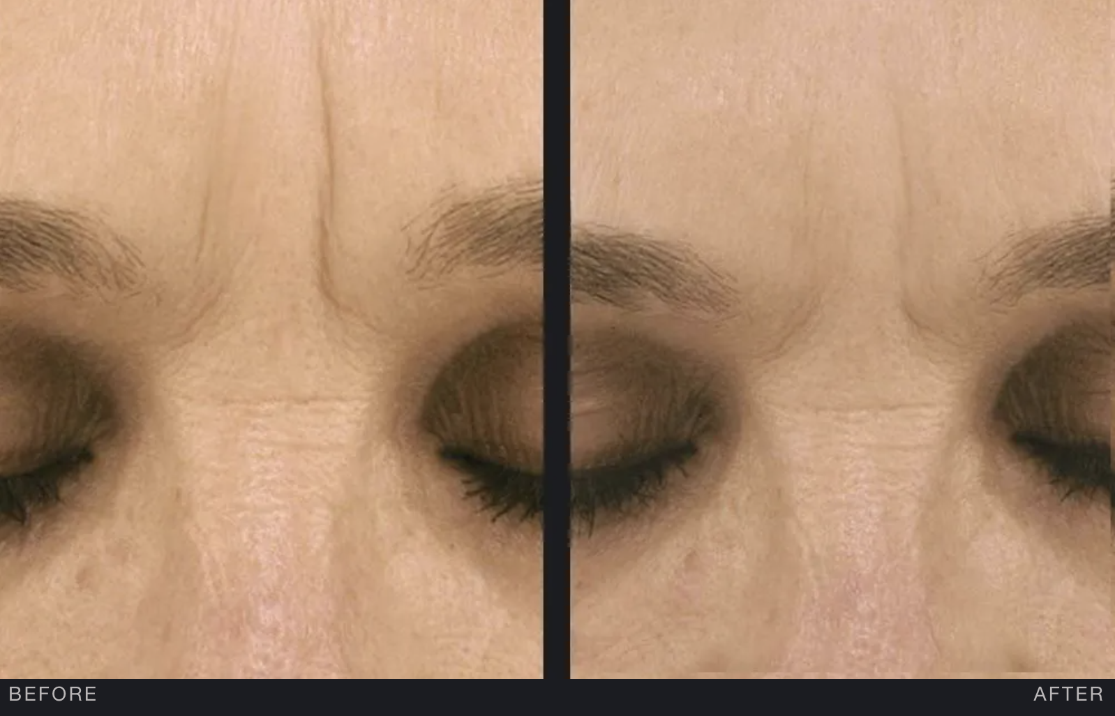 Before Exceed After Exceed Treatment eyebrow
