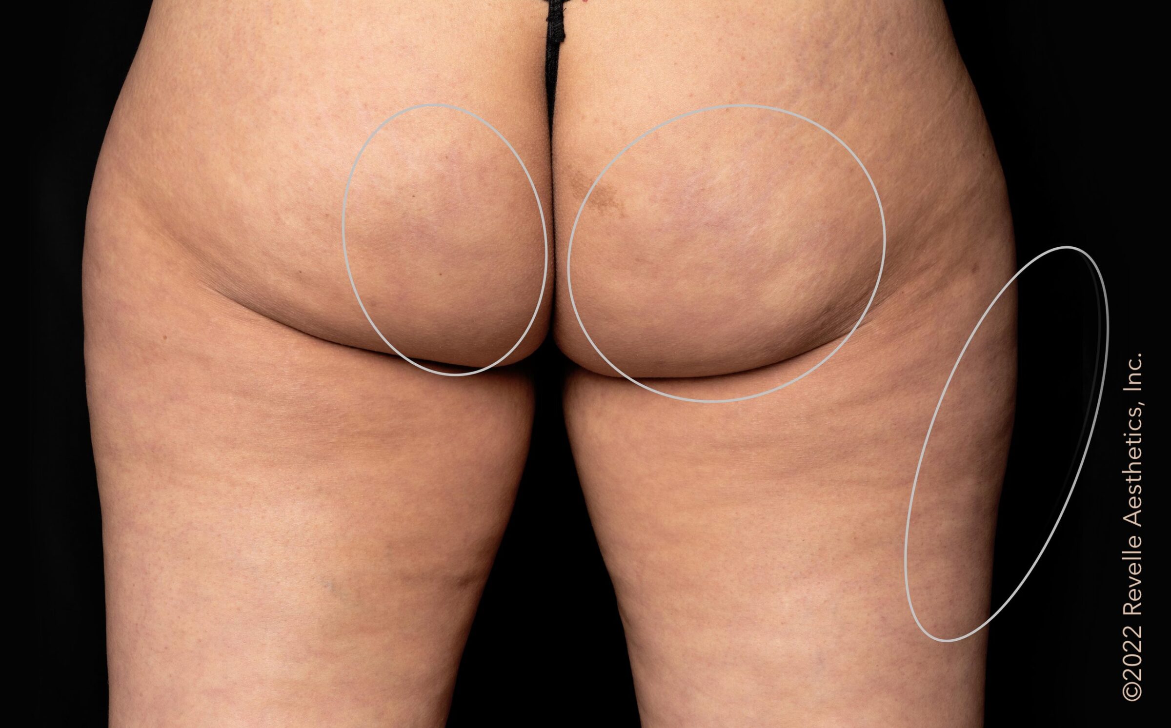 After aveli cellulite treatment