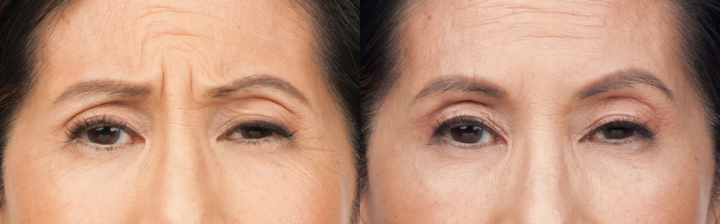 woman frowning before and after botox