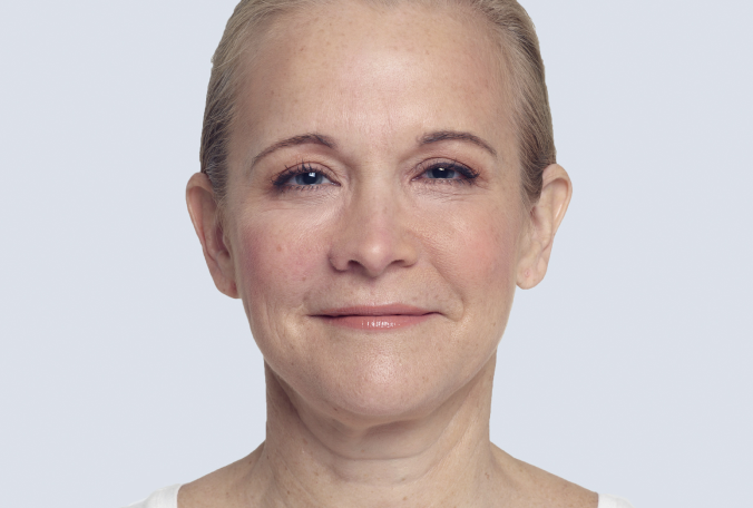 Womans face after treatment with Restylane Lyft