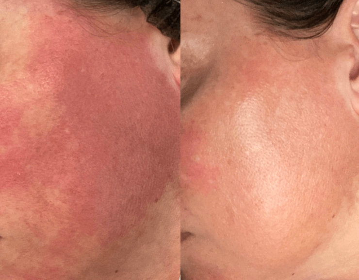 before and after results of using cbd+ on face skin is less red