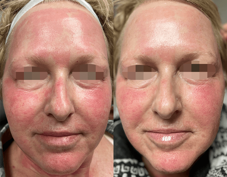 before and after results of using cbd+ on face skin is less blotchy