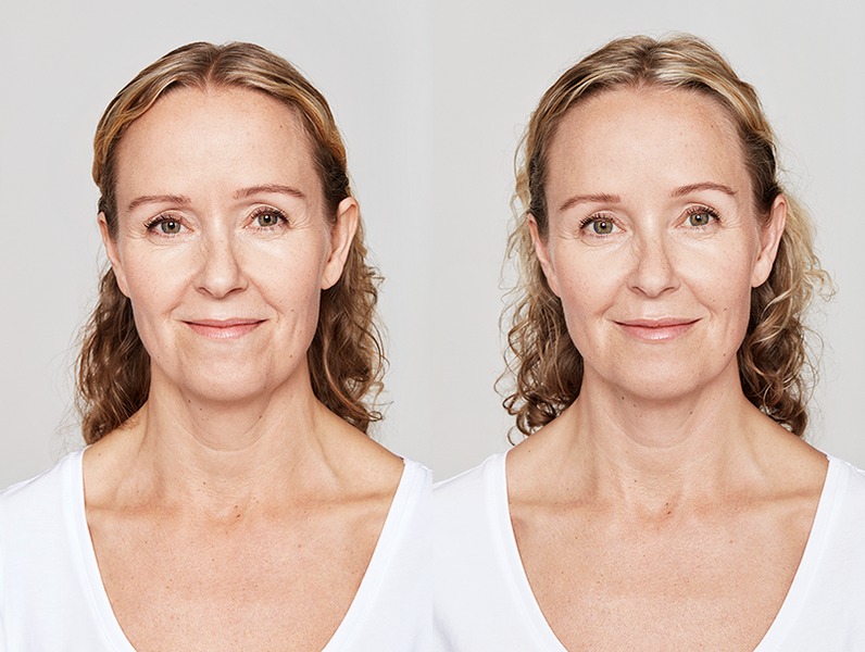 Womans face before and after Restylane treatment
