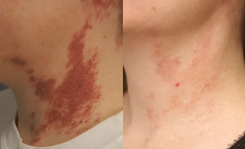 Mans neck before and after receiving ClearV treatment