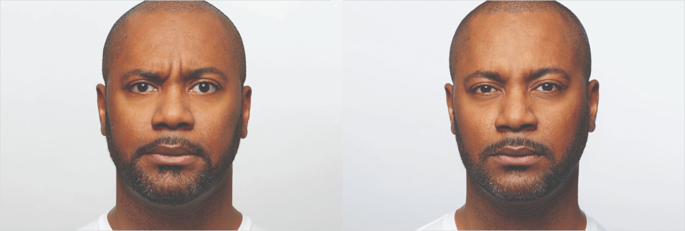 Before & after results of dysport on face