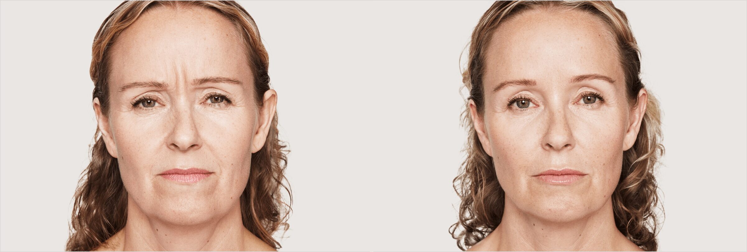 Before & after results of dysport on face