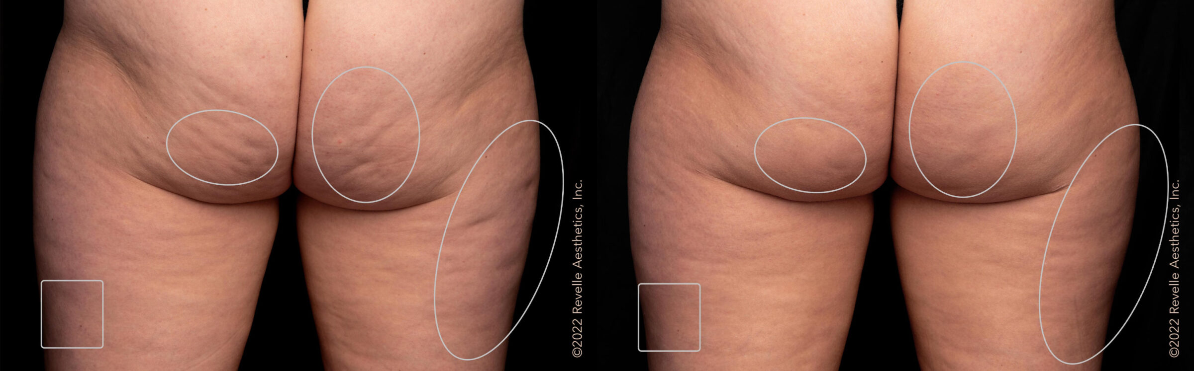 Before and after aveli cellulite treatment on buttocks