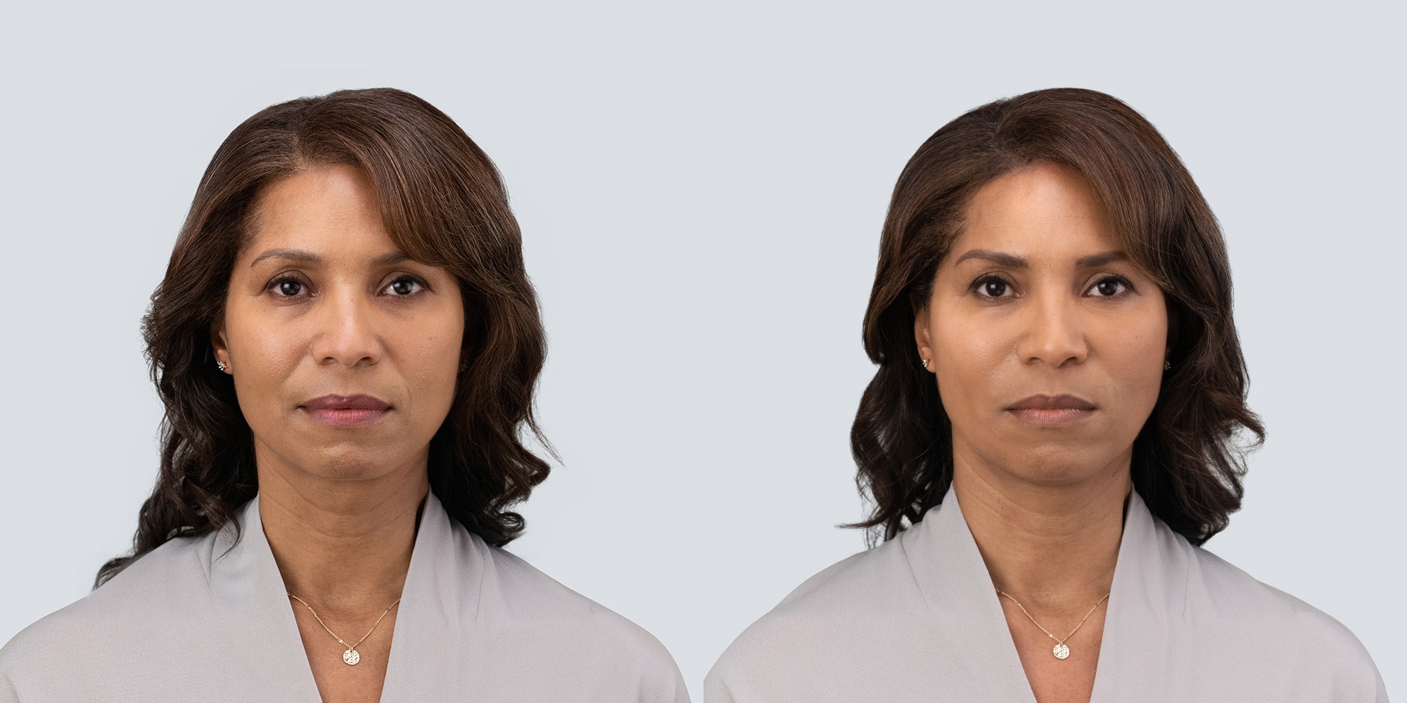 Womans face before and after receiving RHA