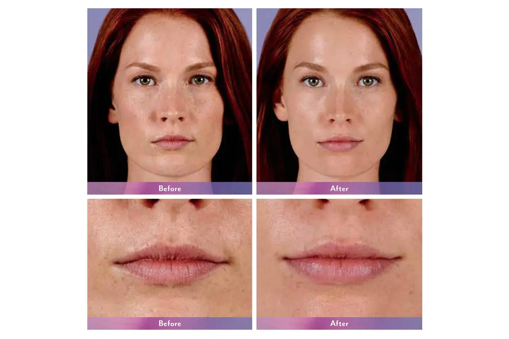 Womans's face before and after Juvederm treatment