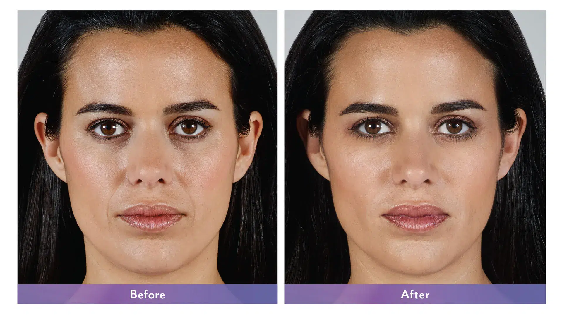 Womans's face before and after Juvederm treatment