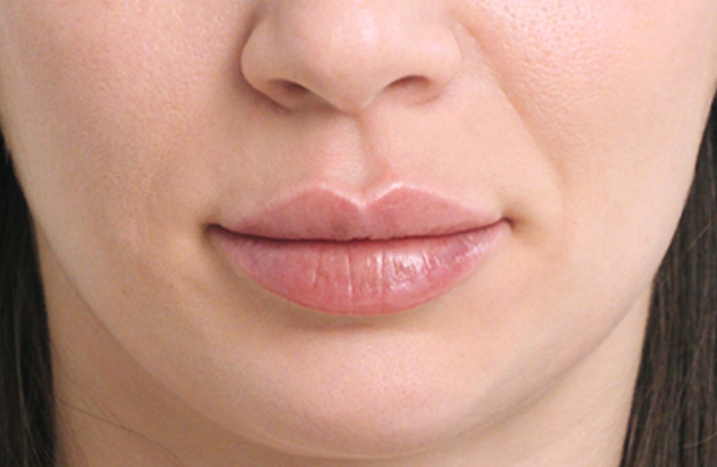 Womans face after treatment with Restylane Refyne