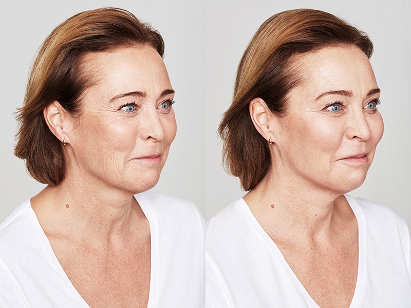 Womans face before and after Restylane treatment