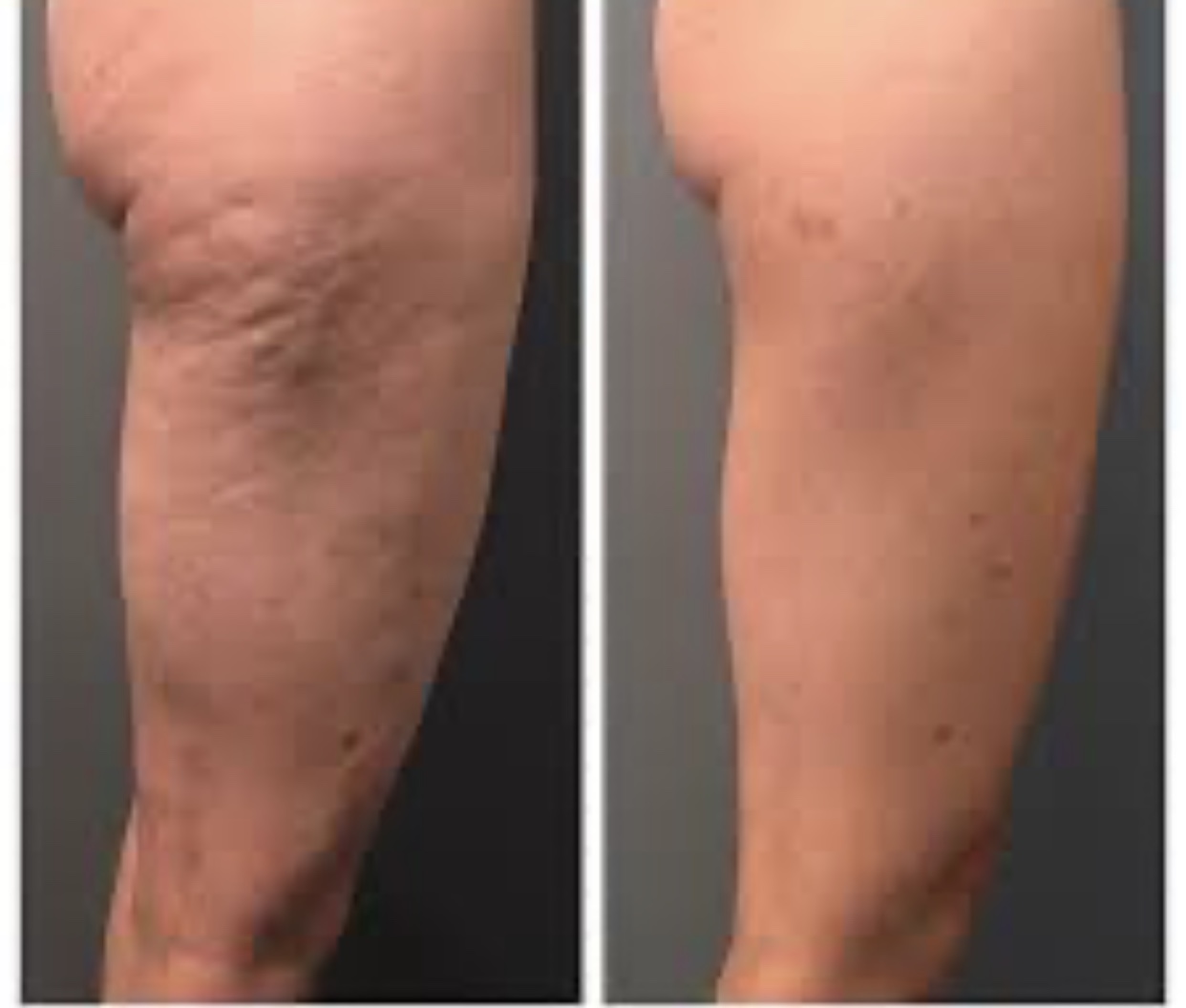 Pre Profound, and post single Profound Treatment of the thigh