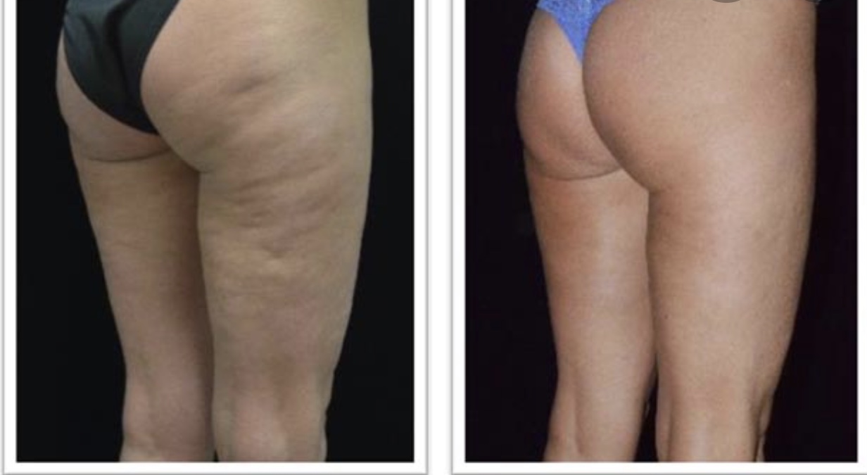 Pre Profound, and post single Profound Treatment of the thigh
