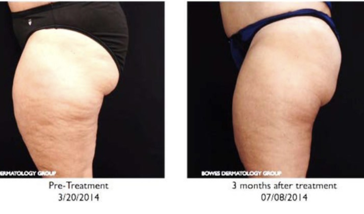 Pre Profound, and 3 months post single Profound Treatment of the thigh