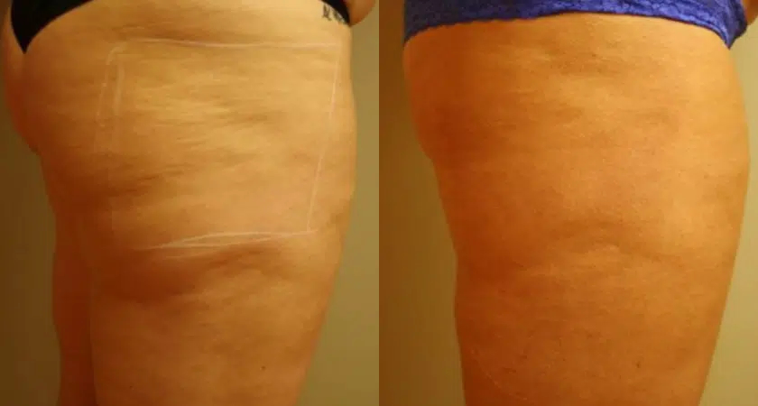 Profound Before and after Single Treatment