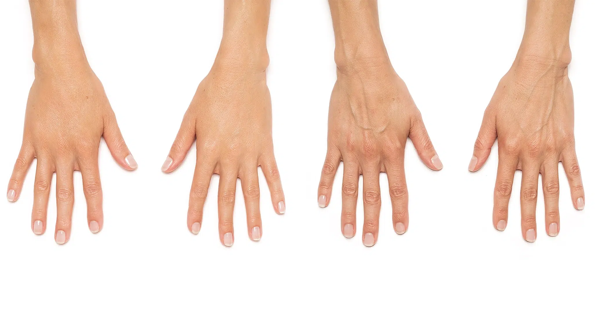 A persons hands before and after receiving Radiesse treatment