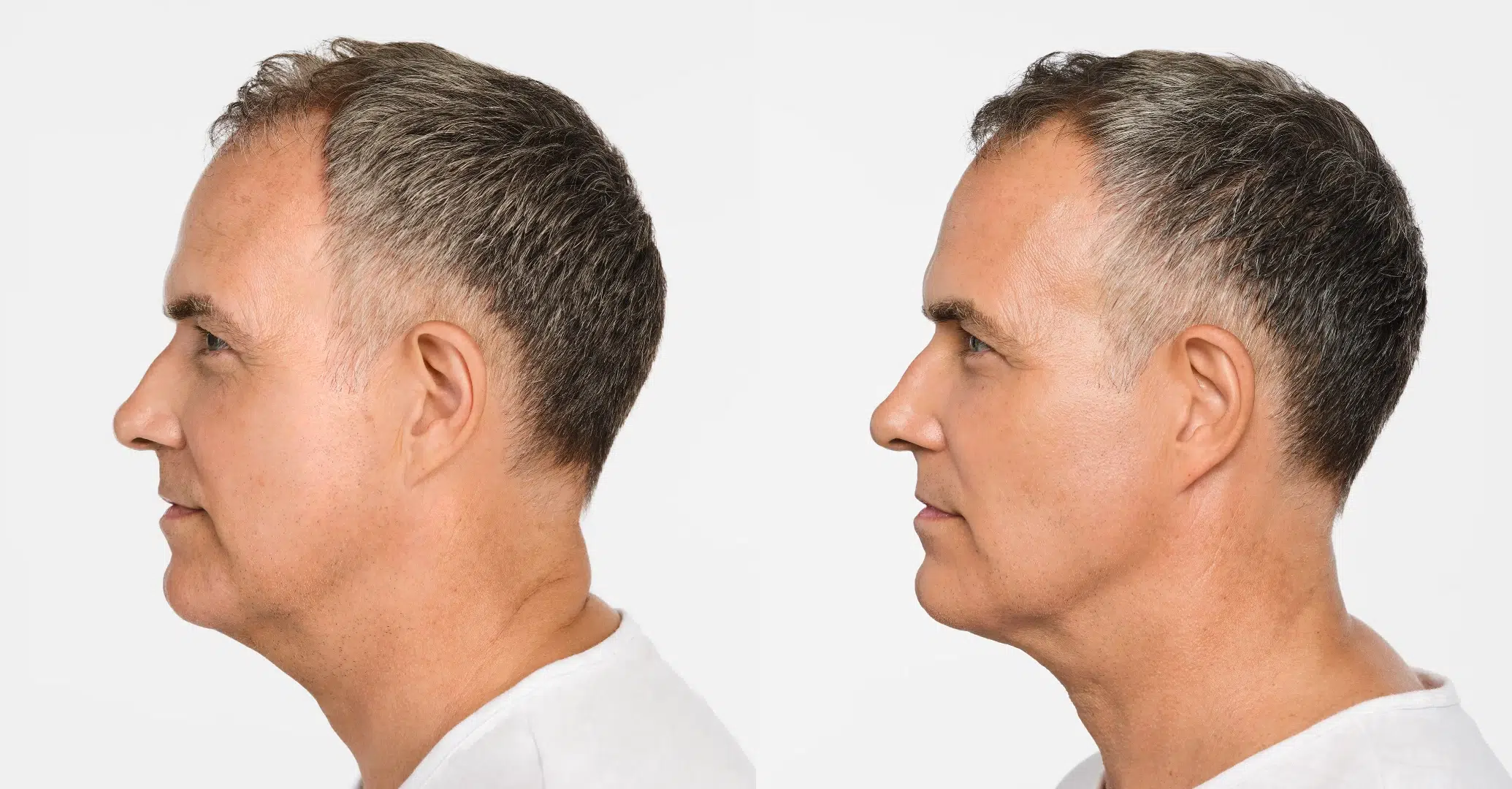 Mans face before and after Radiesse treatment