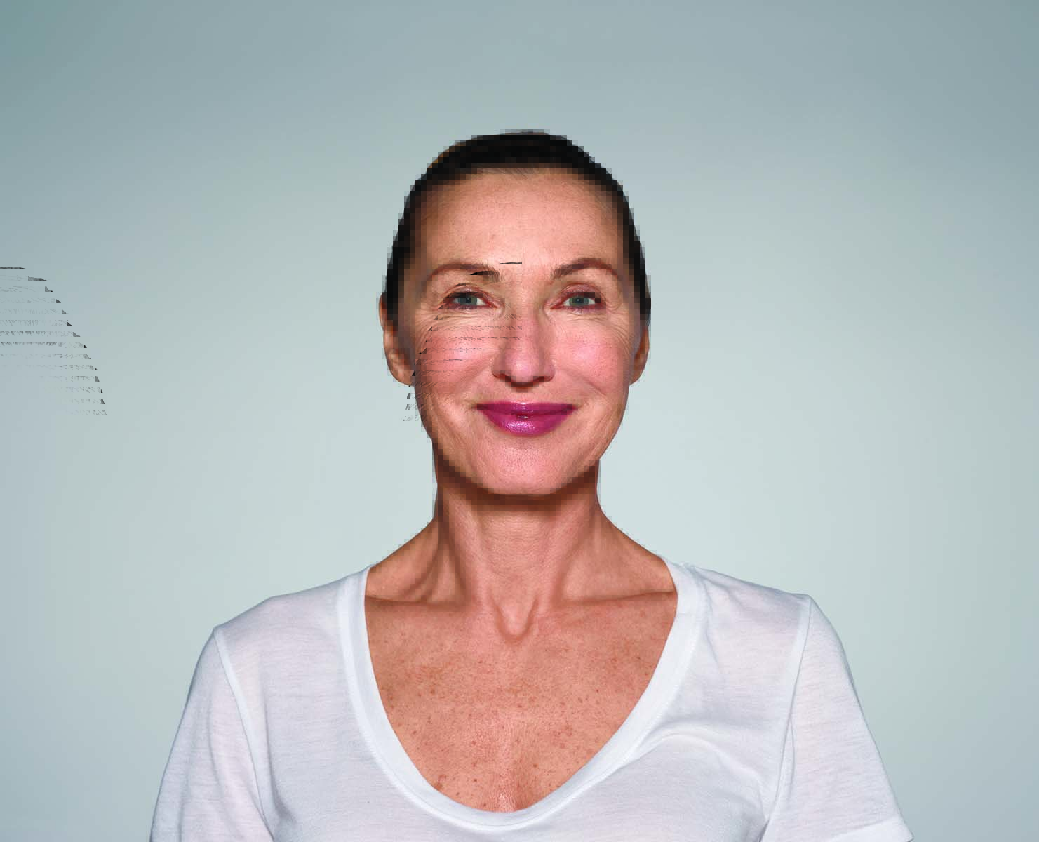 Womans face after treatment with Restylane Refyne