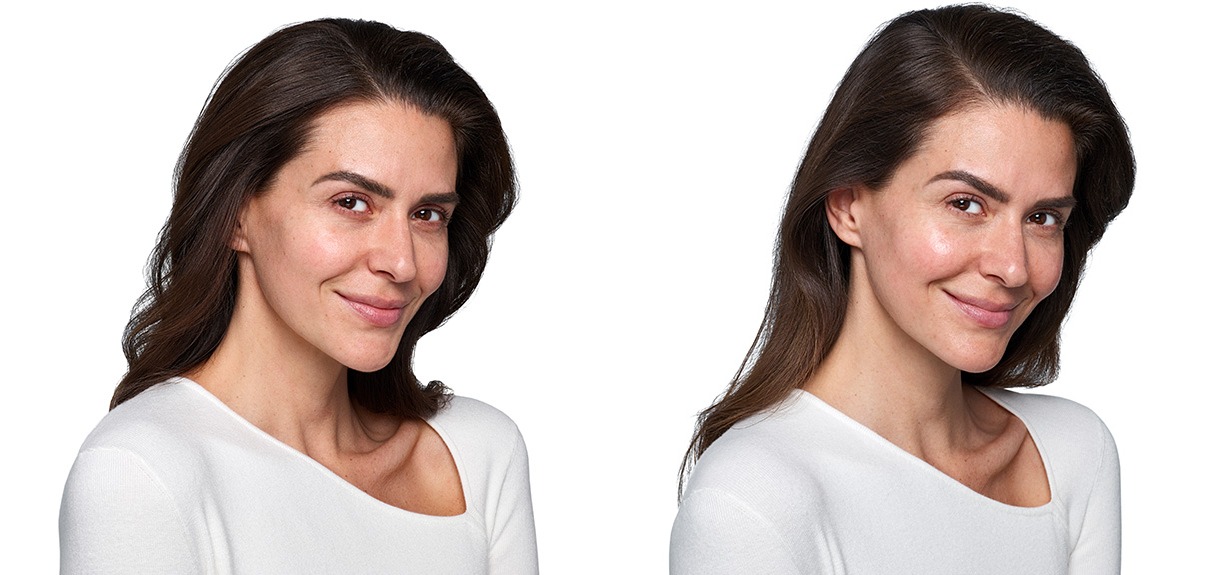 Womans face before and after receiving Skinvive treatment