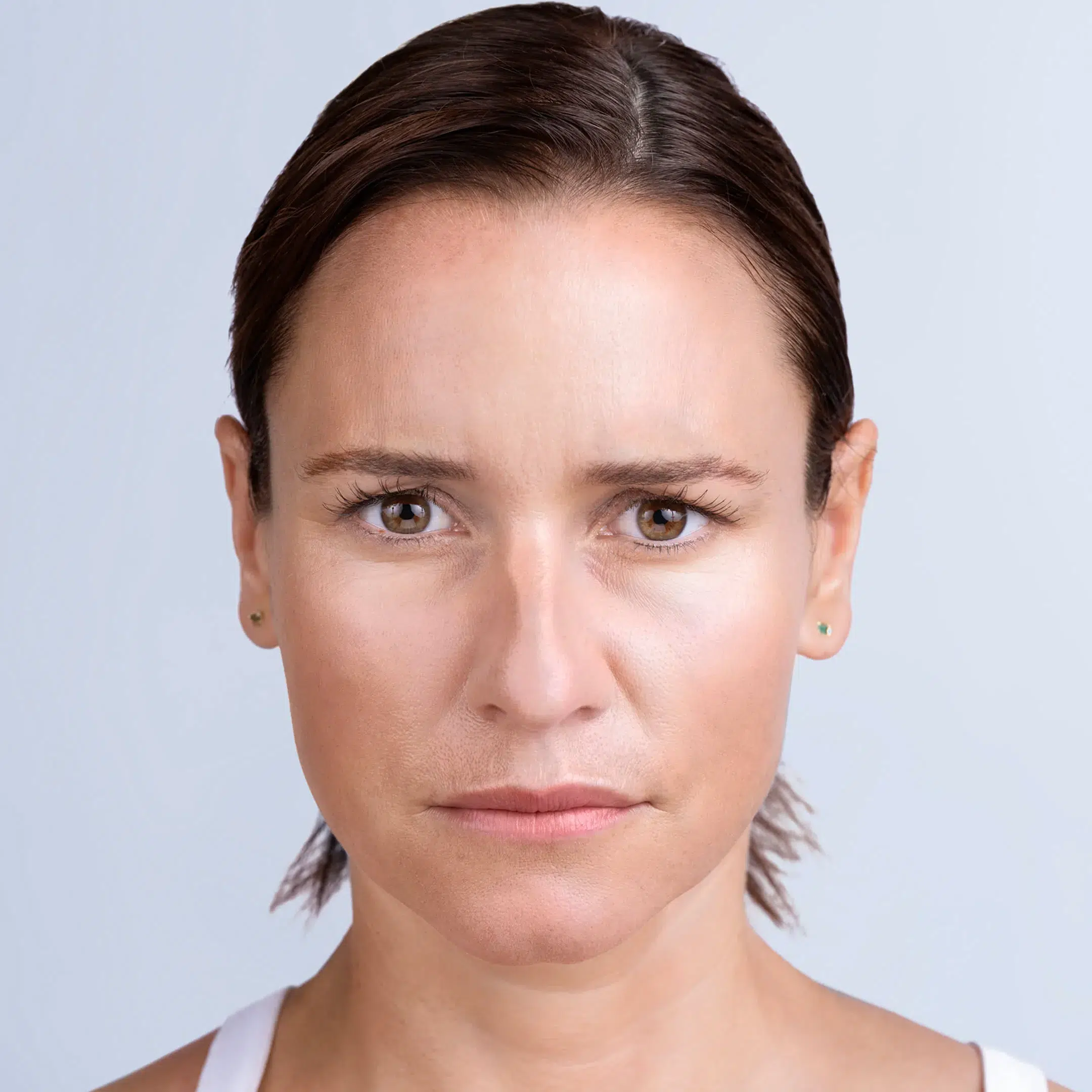 Womans face after Xeomin treatment