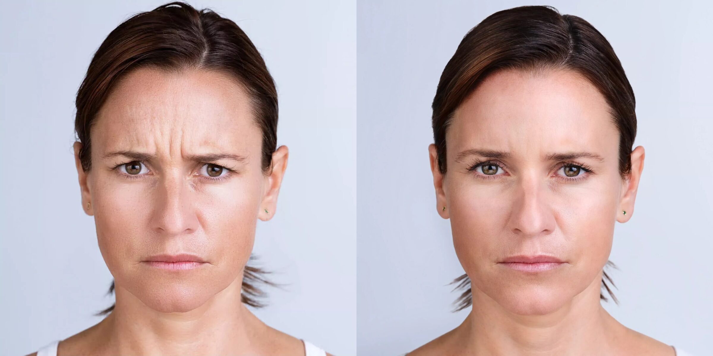 Womans face before and 30 days after Xeomin treatment