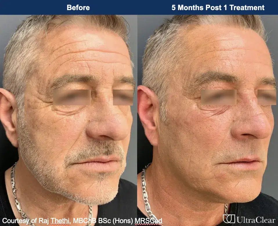 B&A 3