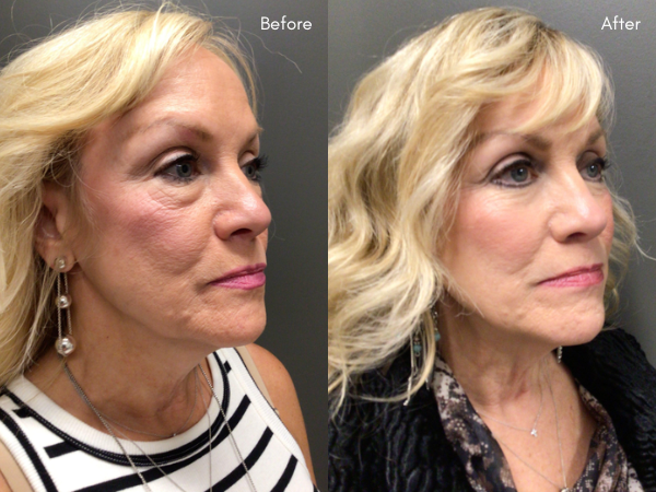 Lower Blepharoplasty — Before and 6 Months Post-Op