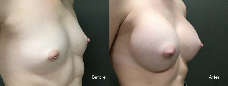 Before & After Breast Augmentation | 415cc Biplanar Submuscular Sientra HSC | 3 Years Post-Op