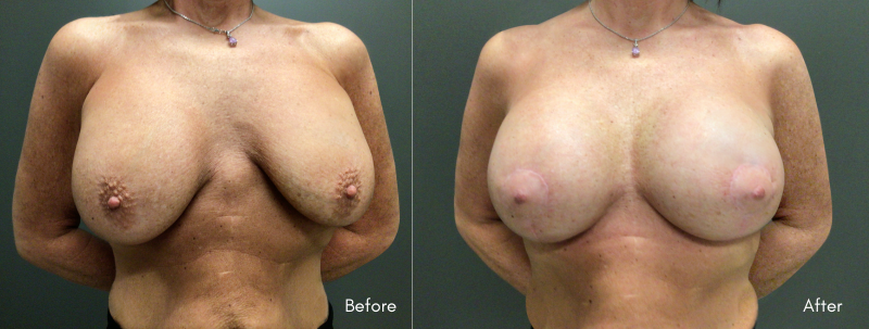 Breast Augumentation | Waterfall Deformity Caused by Old Submuscular Implants From Another Dr. | Replaced with Subfascial Implants (R: 495cc; L: 455cc) + Lift